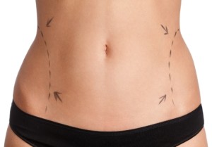 3 Reasons Lipo Could Be Perfect for Eliminating Your Love Handles img 1